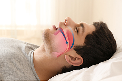 Sleep-Apnea-Treatment-in-Sheridan-WY